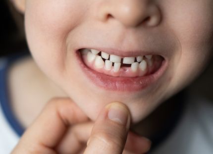 Aikuinen raottaa lapset suuta ja katsoo tämän hampaita. Suussa maitohampaita, joista yksi irronnut.