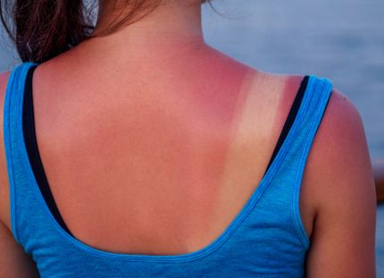 Nuoremmissa ikäryhmissä auringonotto on lisääntynyt. Nuoren selkä, jossa näkyy auringossa palanut selkä ja rusketusrajat.