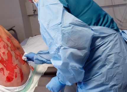 Hoitaja suojavarusteissa hoitamassa potilaan selässä olevia vakavia palovammoja.