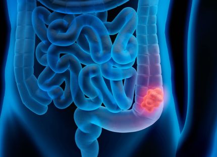 Pirroskuva ihmisen suolistosta, jossa havaittu syöpäkasvain.