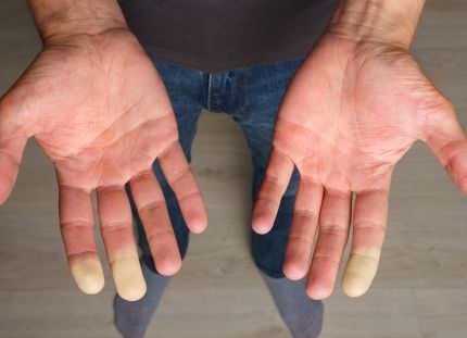 Kädet, joiden sormien päät ovat valkoiset.