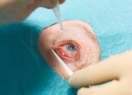 Silmän ympäristö on suojattu leikkausliinalla. Hoitaja tiputtaa silmätippoja ennen injektiota.