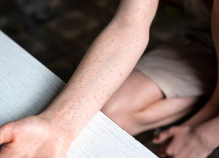 Ruotsissa on käynnissä tuhkarokkoepidemia. Nuoren kädessä tuhkarokkoihottumaa.